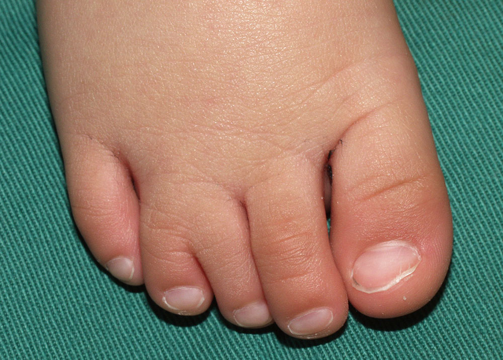形成外科シリーズ ⑤　先天性の手足の変形　合趾症術前